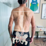 Quando o corpo “entorta” por causa da dor: entenda o que é o Lateral Shift